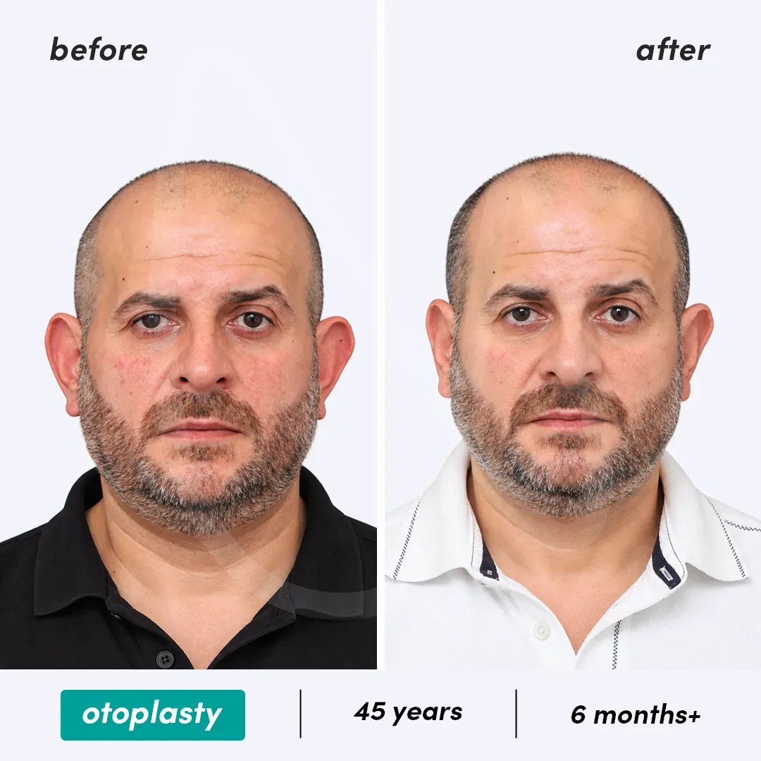 Otoplastie before and after