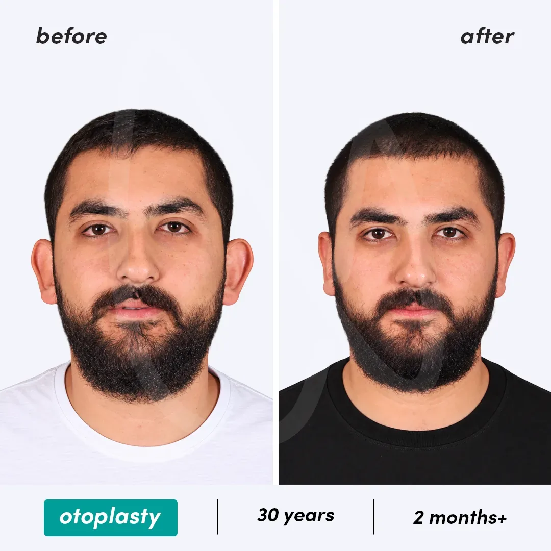 Otoplastie before and after