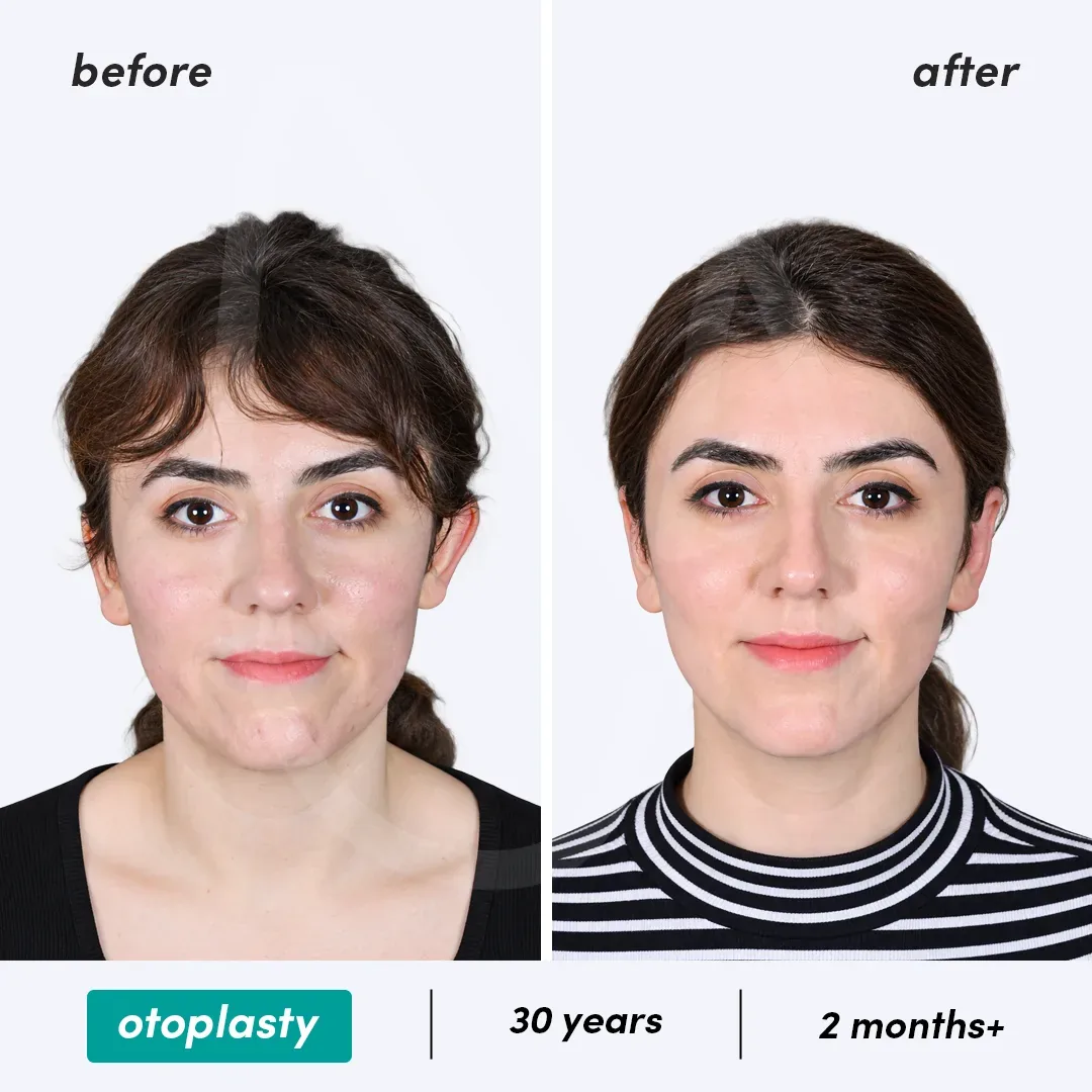 Otoplastie before and after