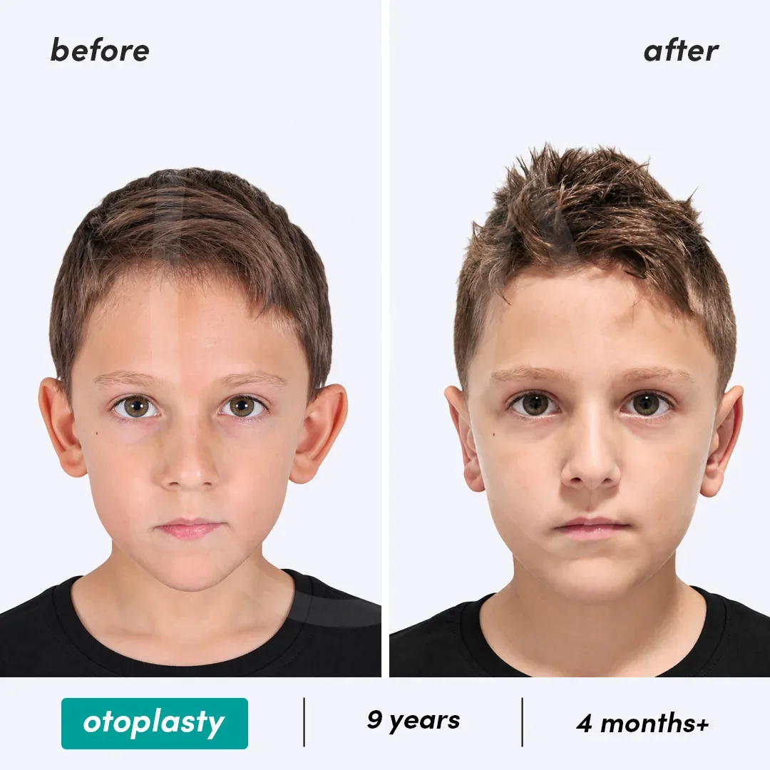 Otoplastie before and after