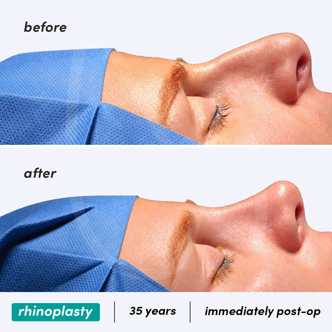 Rhinoplastie before and after