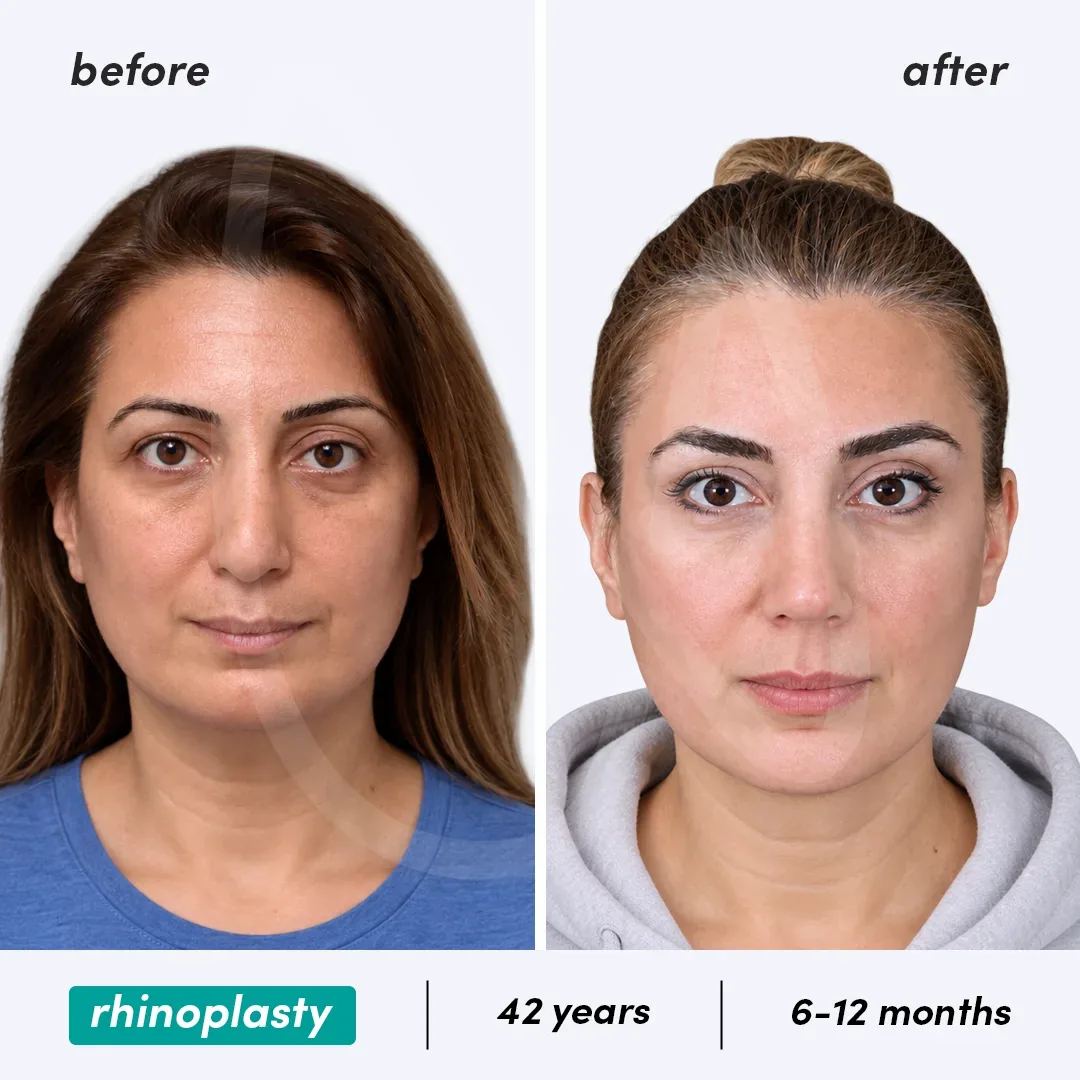 Rhinoplastie before and after