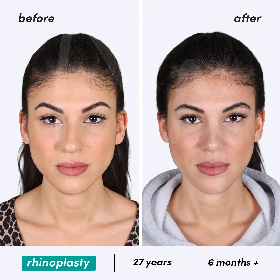 Rhinoplastie before and after