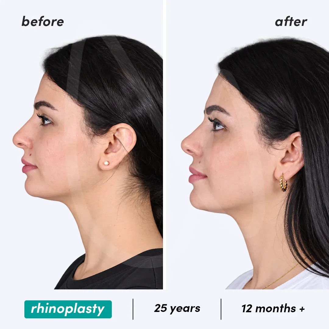 Rhinoplastie before and after