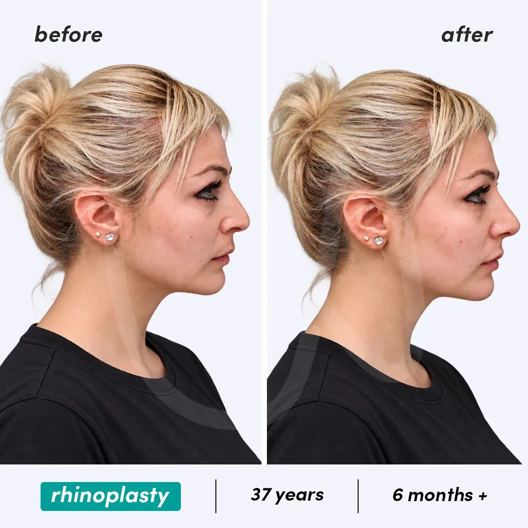 Rhinoplastie before and after
