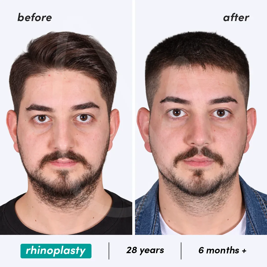 Rhinoplastie before and after