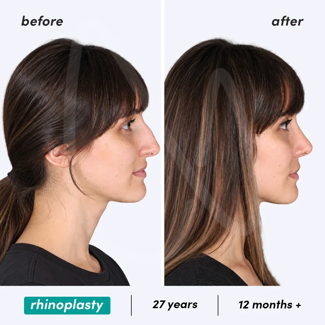 Rhinoplastie before and after