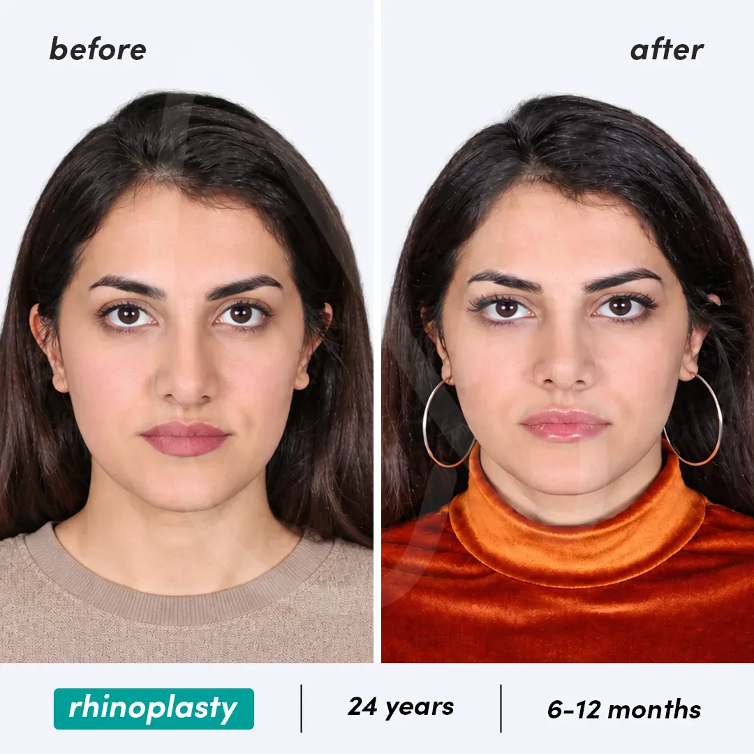 Rhinoplastie before and after