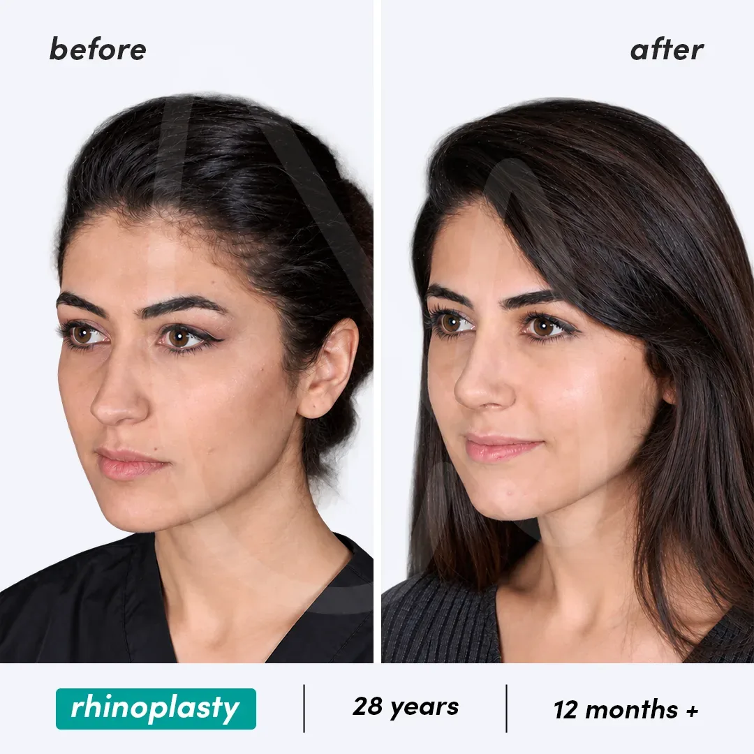 Rhinoplastie before and after