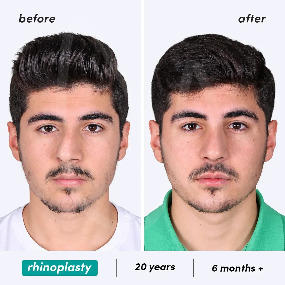 Rhinoplastie before and after
