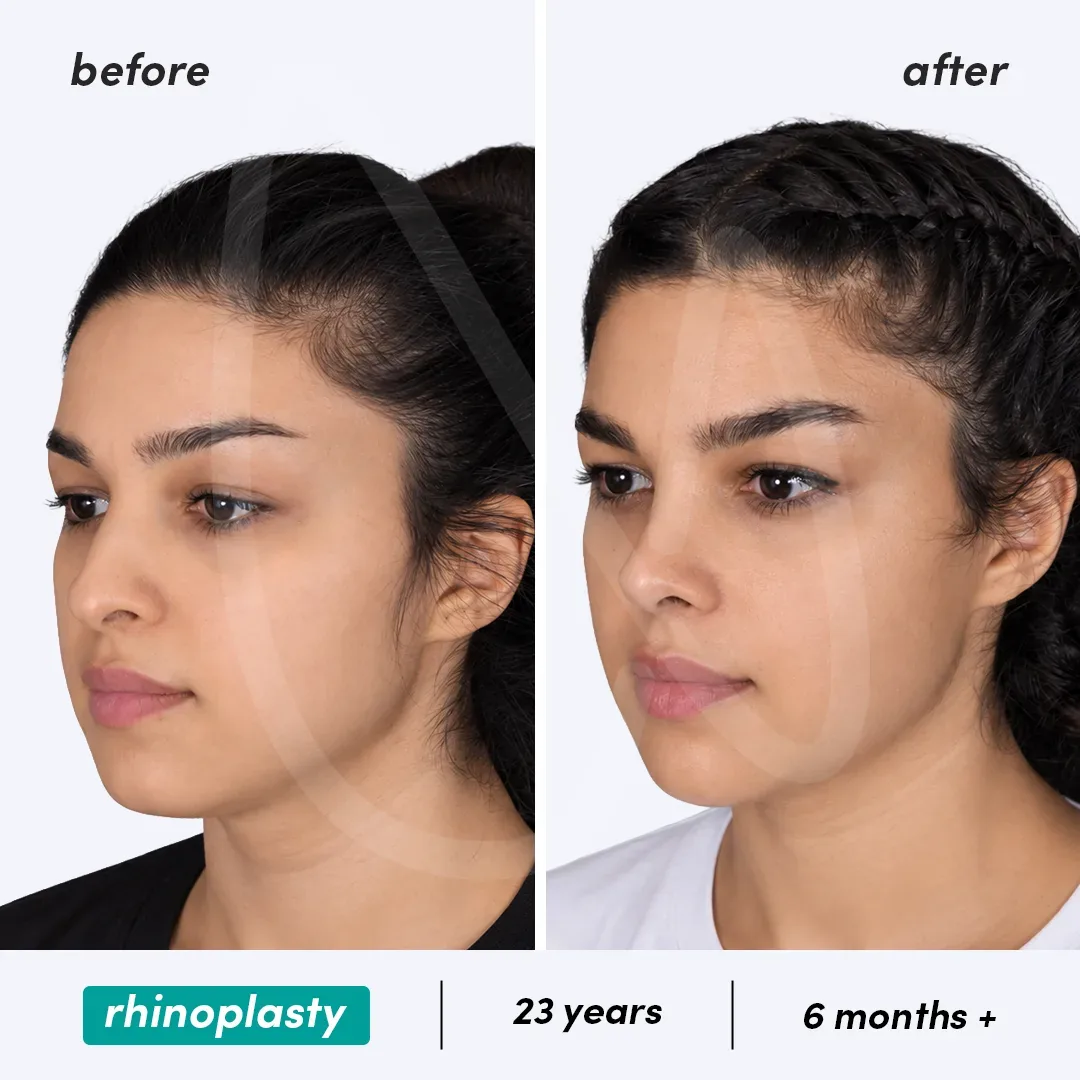 Rhinoplastie before and after