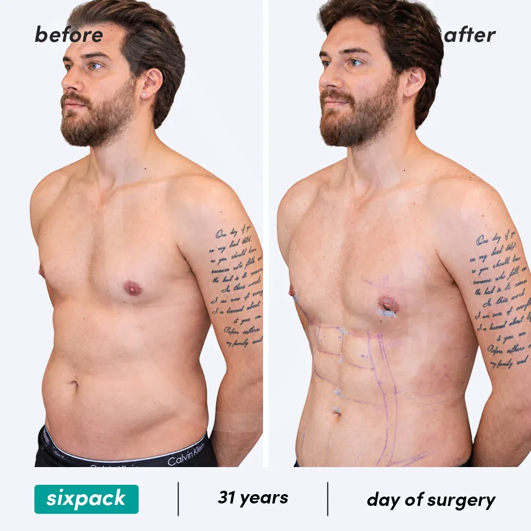 Chirurgie du Six-pack before and after