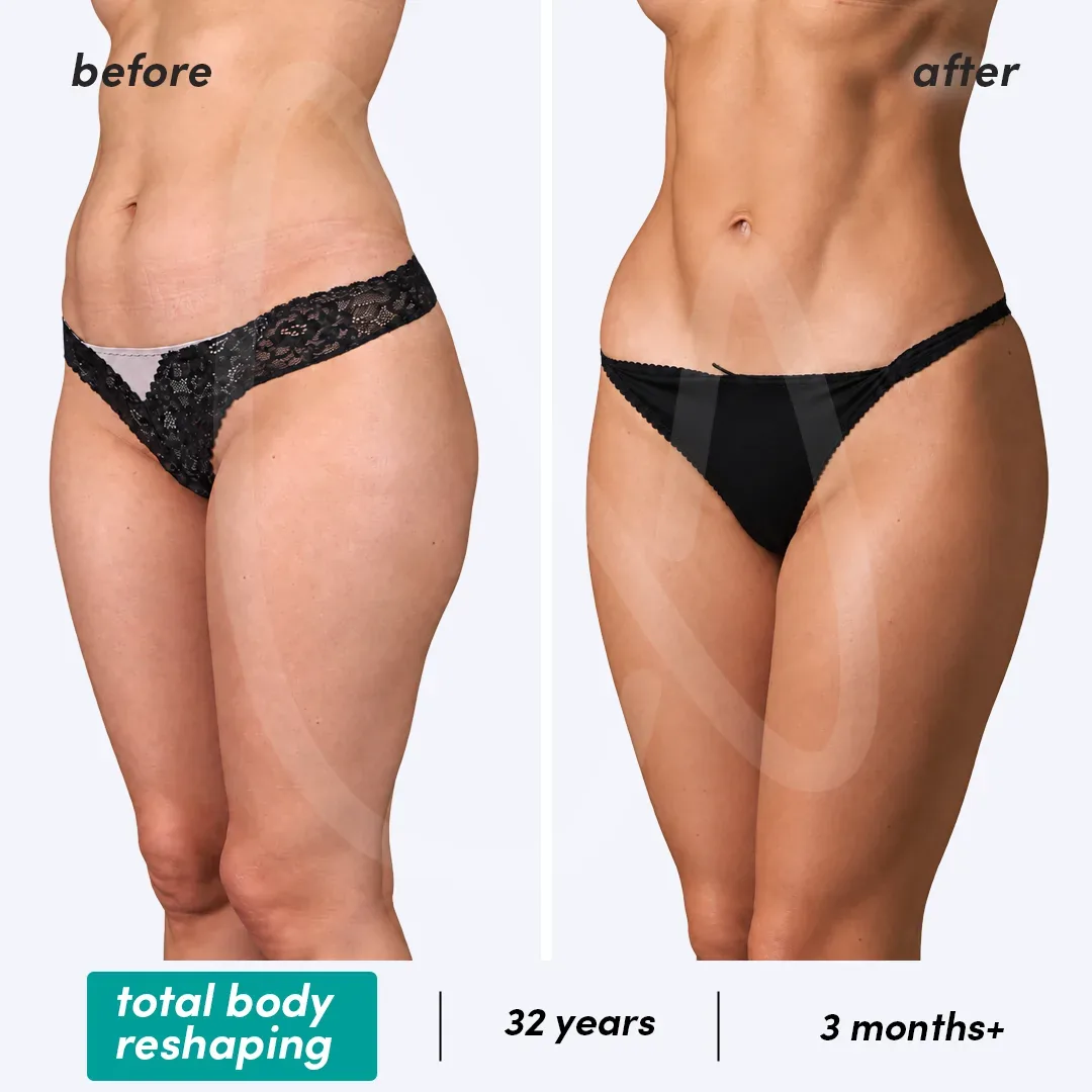 Restructuration Totale du Corps before and after