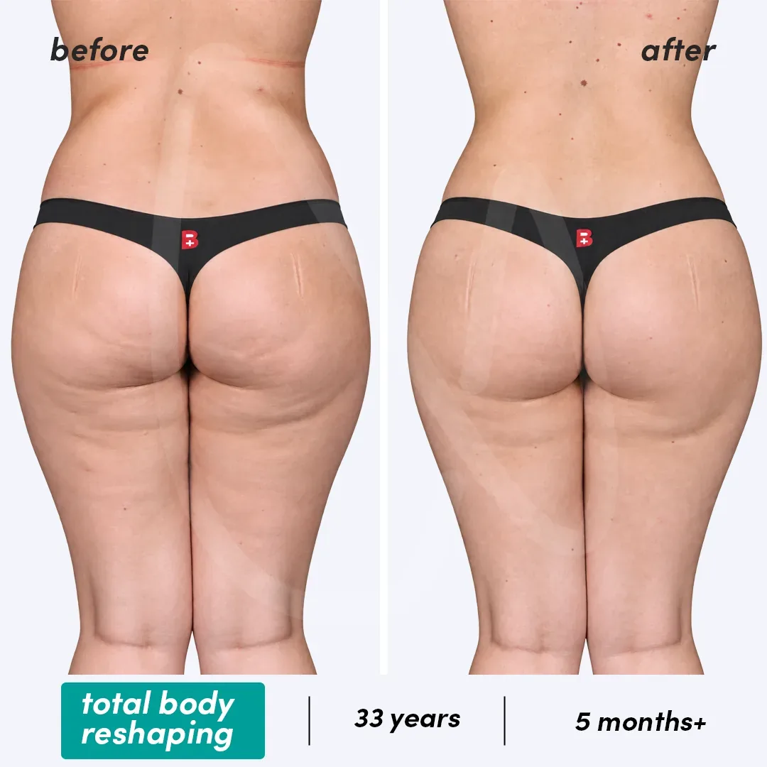 Restructuration Totale du Corps before and after