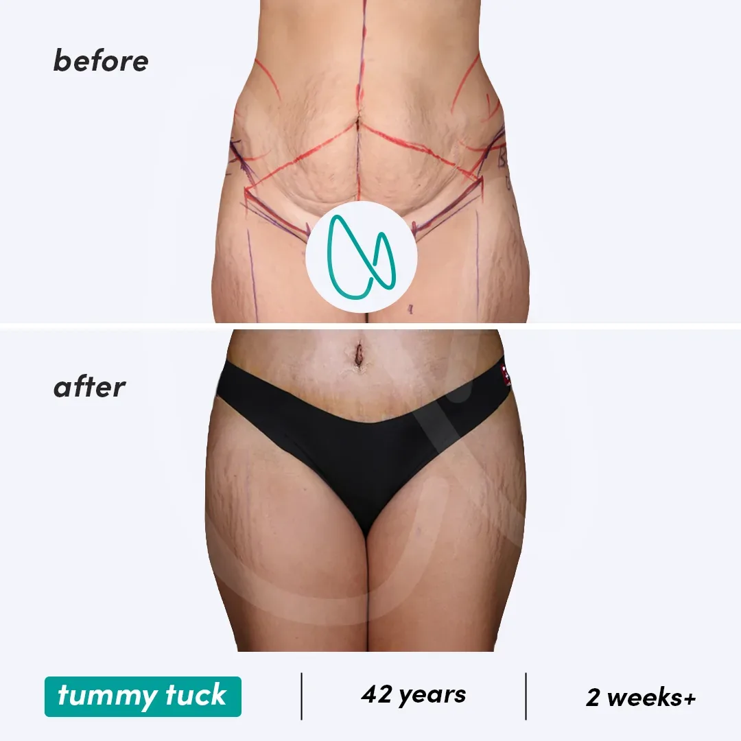Abdominoplastie before and after