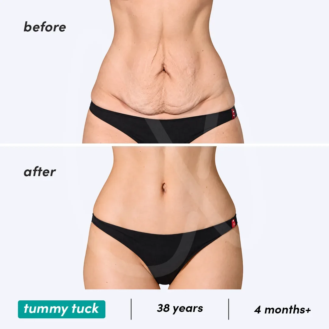 Abdominoplastie before and after