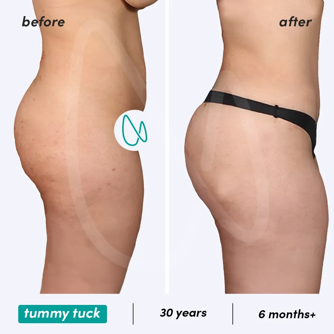 Abdominoplastie before and after