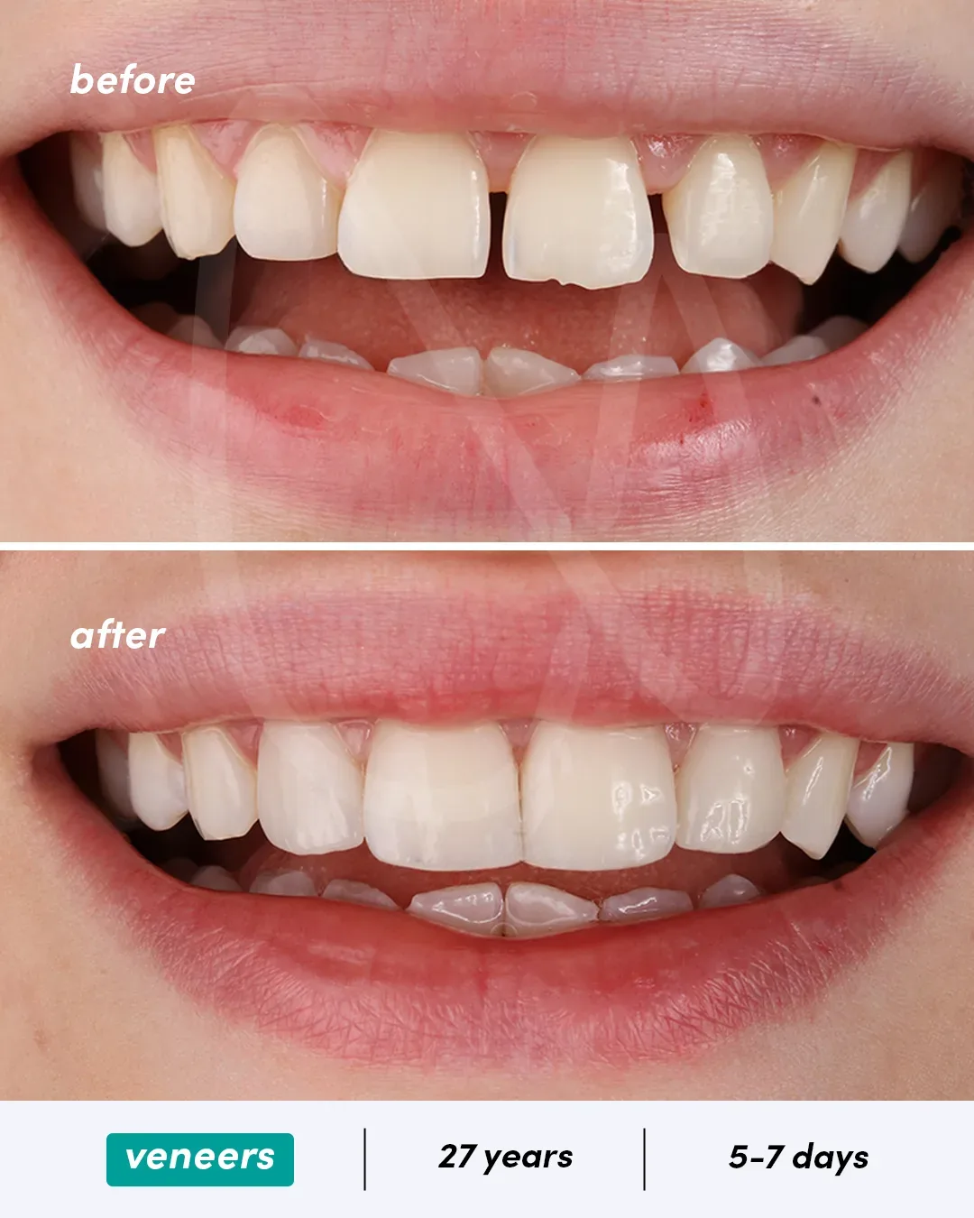 Facettes dentaires before and after