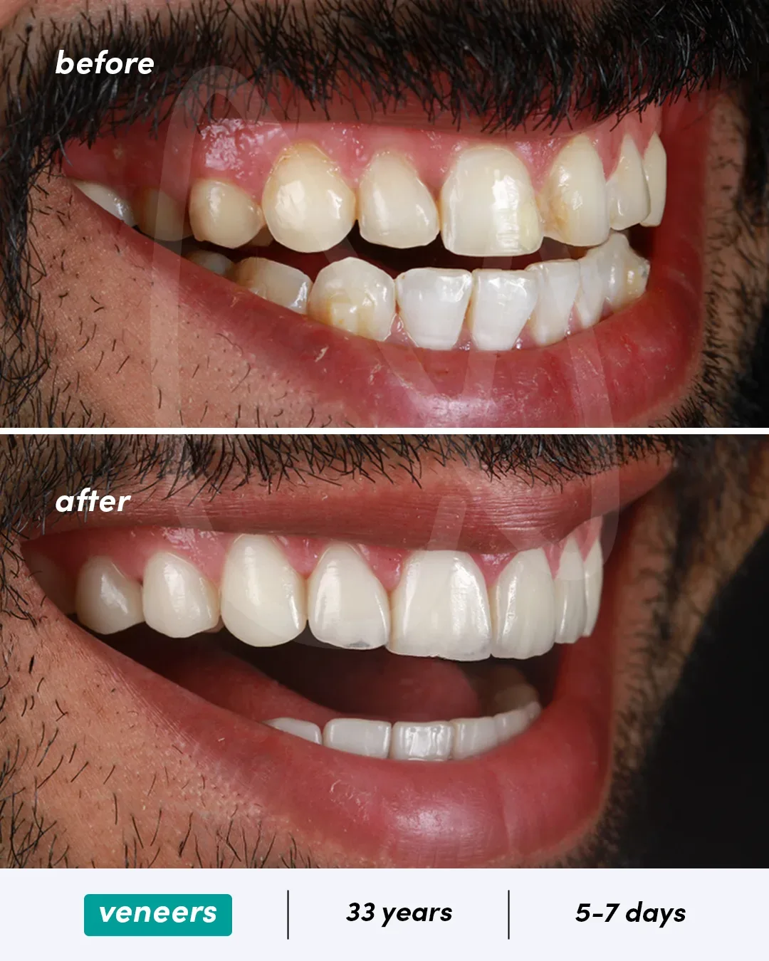 Facettes dentaires before and after