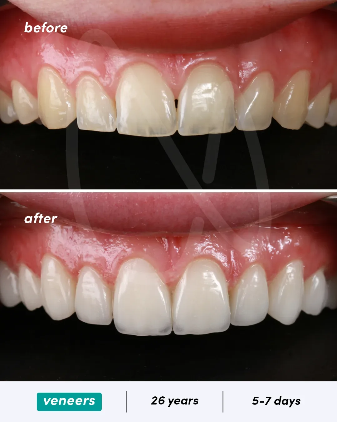 Facettes dentaires before and after