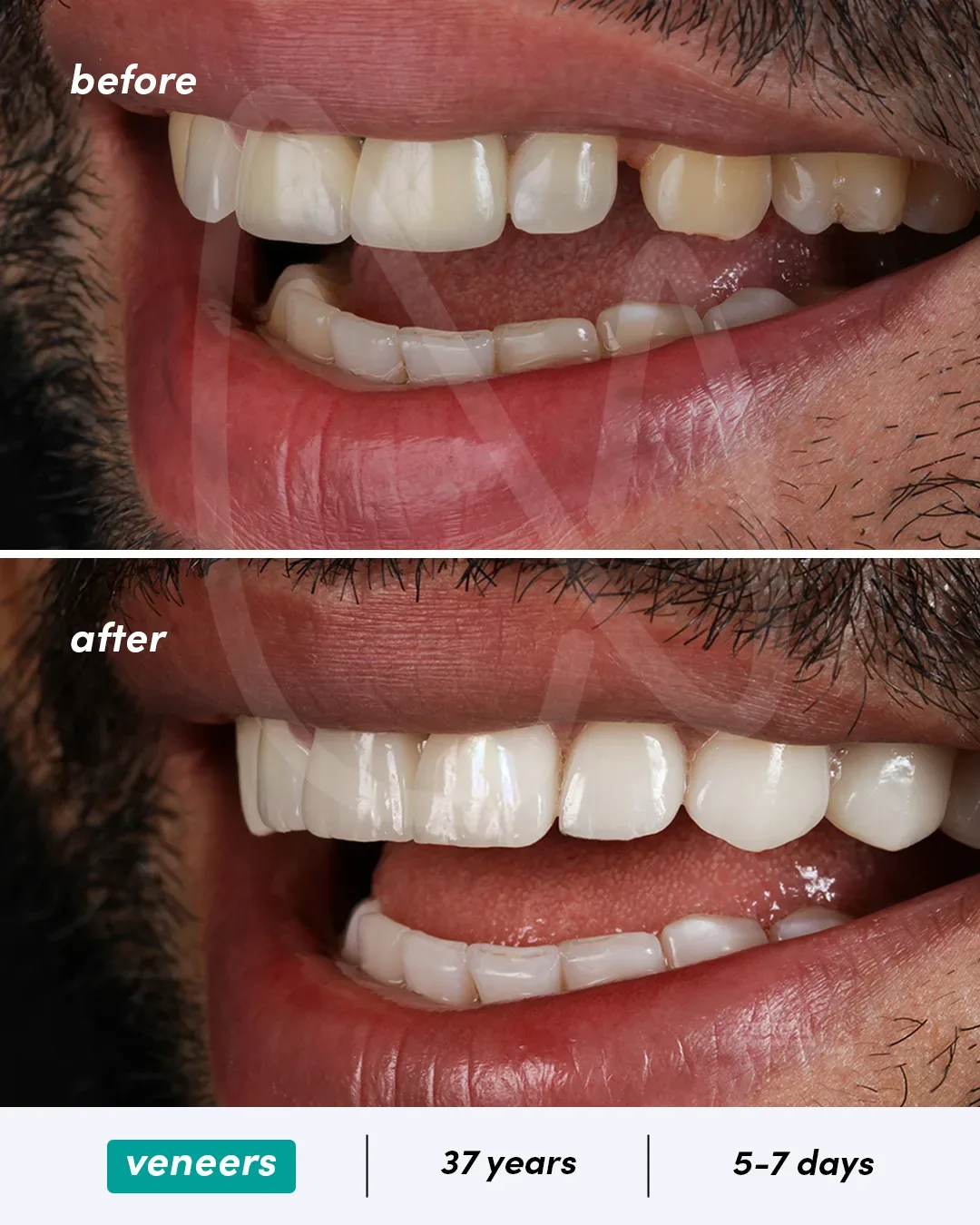 Facettes dentaires before and after