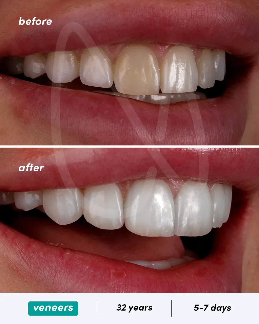 Facettes dentaires before and after