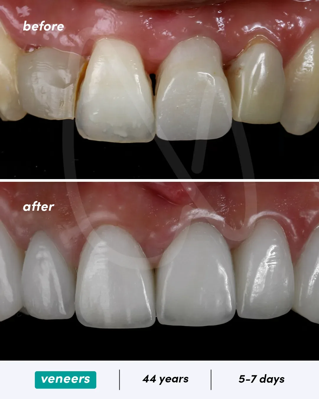 Facettes dentaires before and after