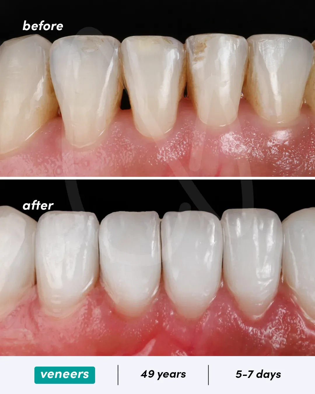 Facettes dentaires before and after