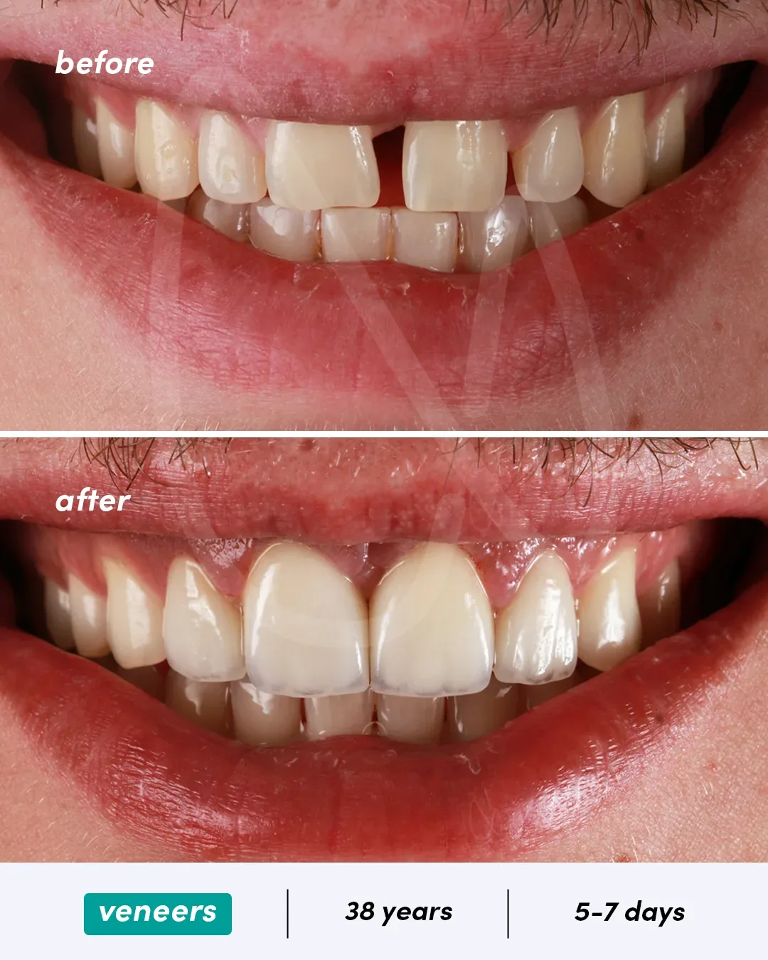 Facettes dentaires before and after
