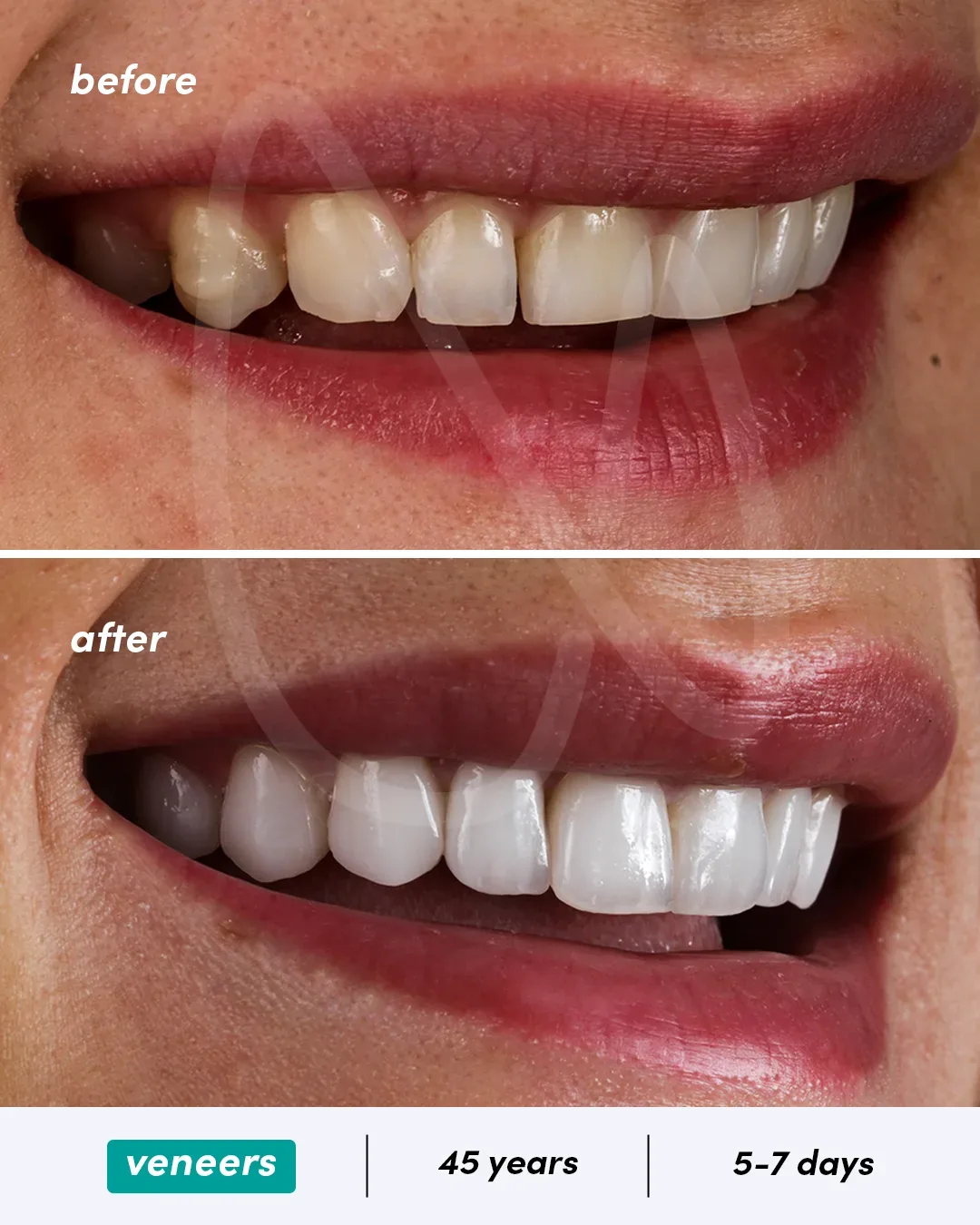 Facettes dentaires before and after