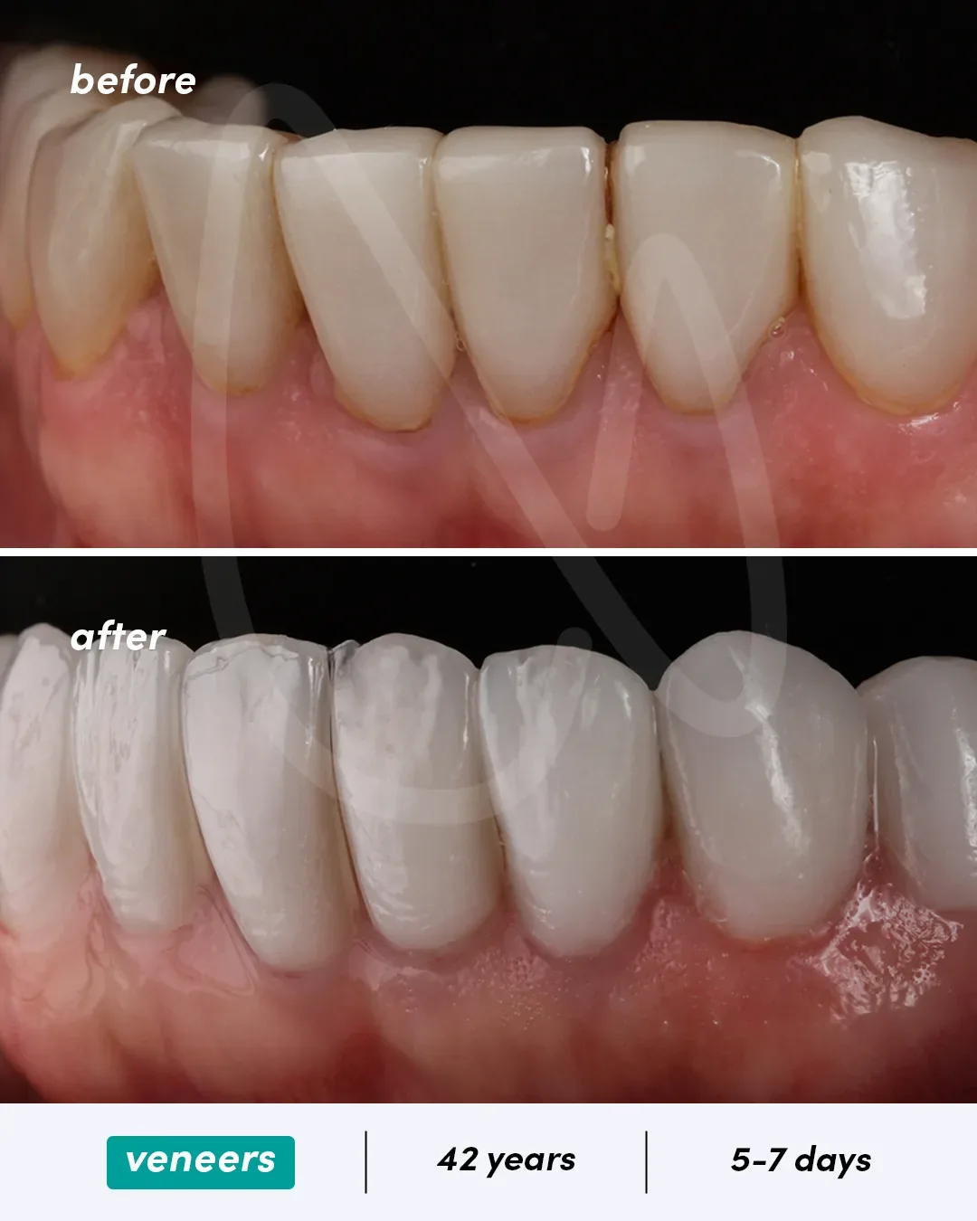 Facettes dentaires before and after