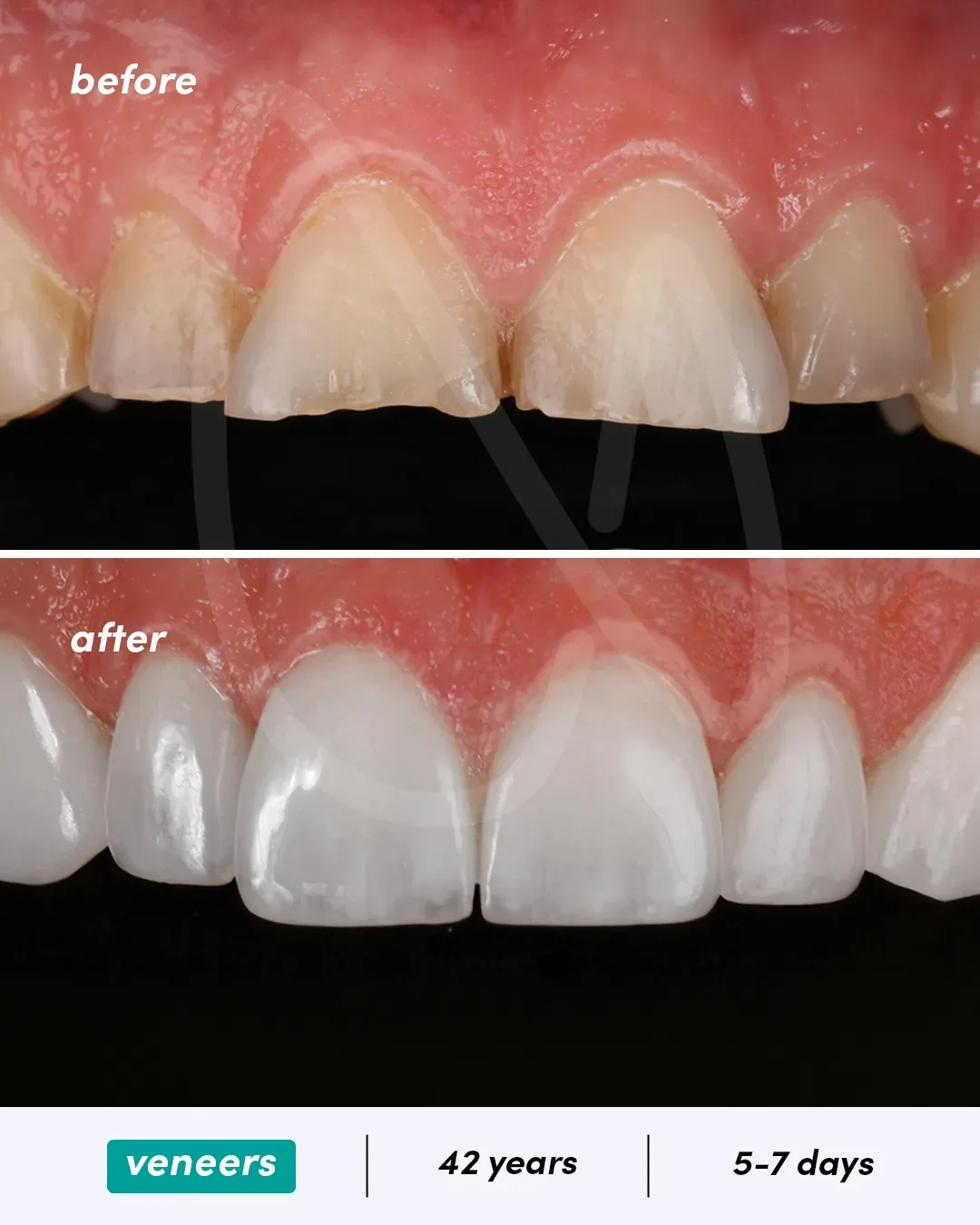 Facettes dentaires before and after