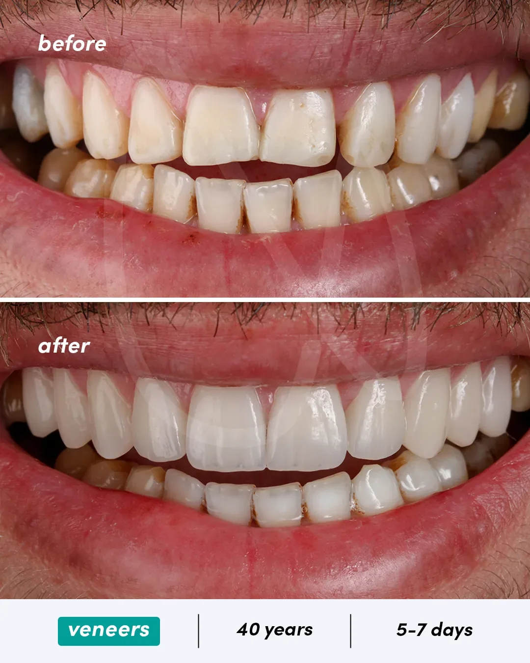 Facettes dentaires before and after
