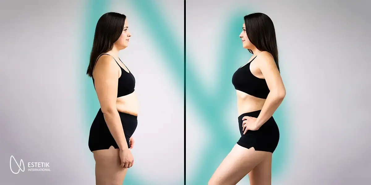 After Major Weight Loss: How a 360 Body Lift Can Restore Your Shape and Confidence
