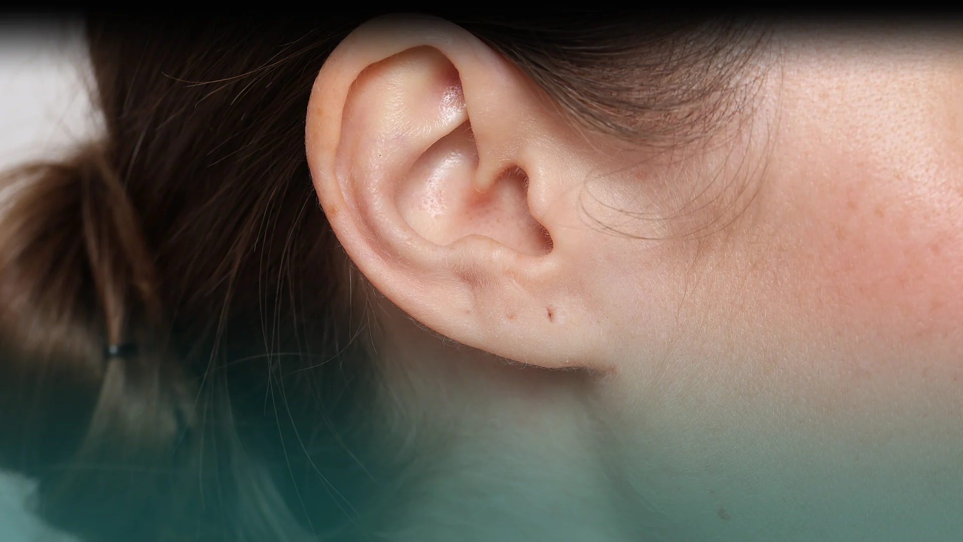 Otoplasty