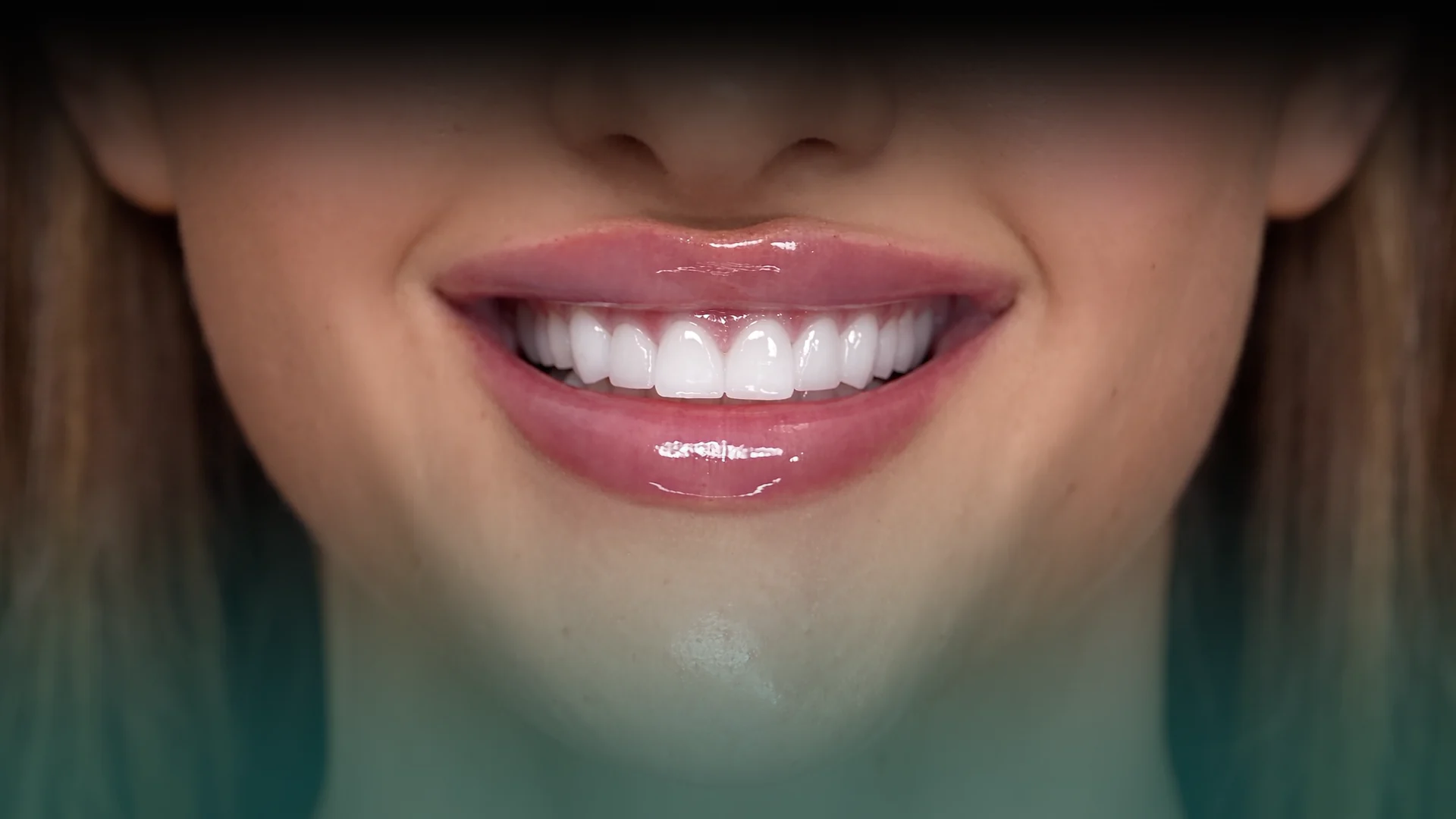 Smile Makeover