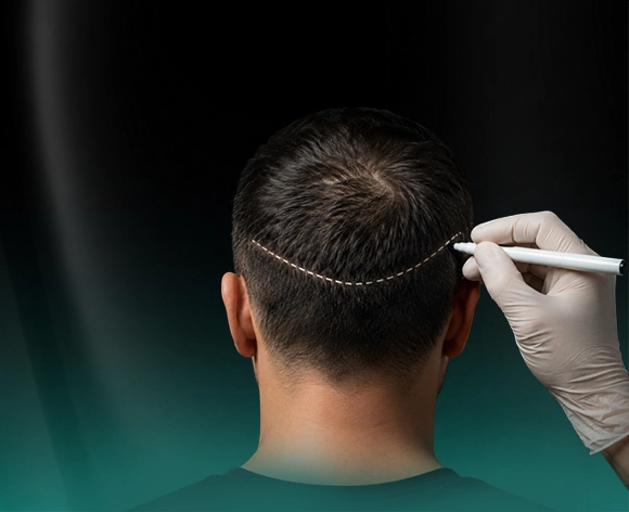 Hair Transplant