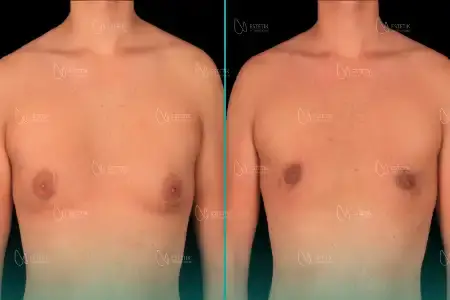 Before-After Combined