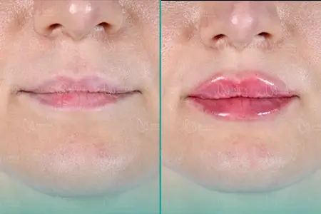 Before-After Combined