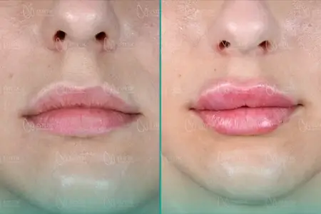 Before-After Combined