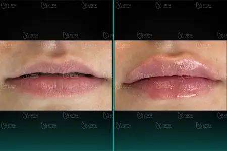 Before-After Combined