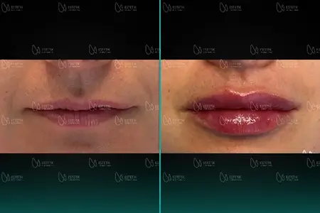 Before-After Combined