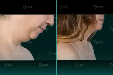 Before-After Combined