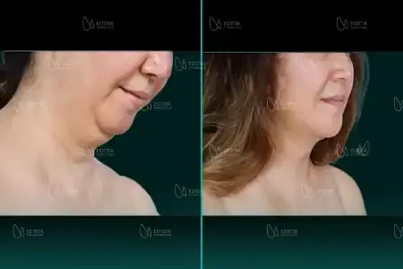 Before-After Combined