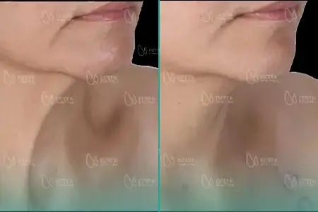 Before-After Combined