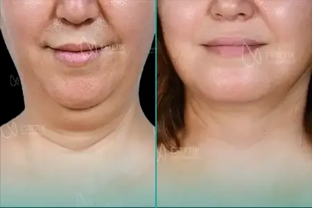 Before-After Combined
