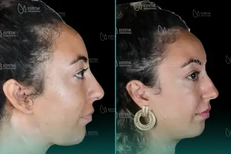 Before-After Combined