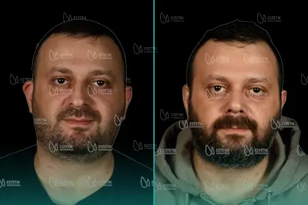 Before-After Combined
