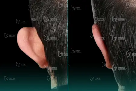 Before-After Combined