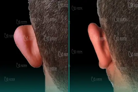 Before-After Combined